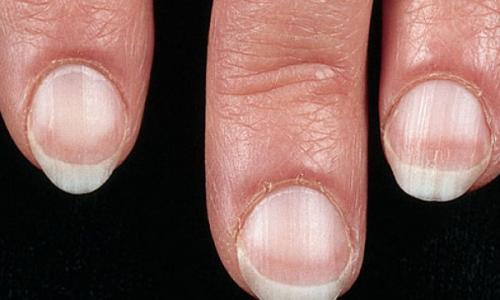 Рак можно диагностировать по ногтям